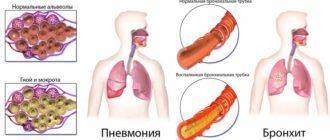 Отличия пневмонии и бронхита от туберкулеза