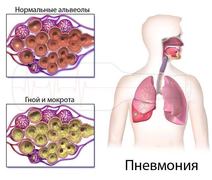 Признаки пневмонии
