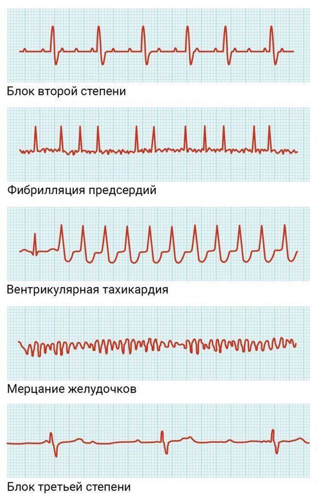 Разновидности нарушений сердечного ритма