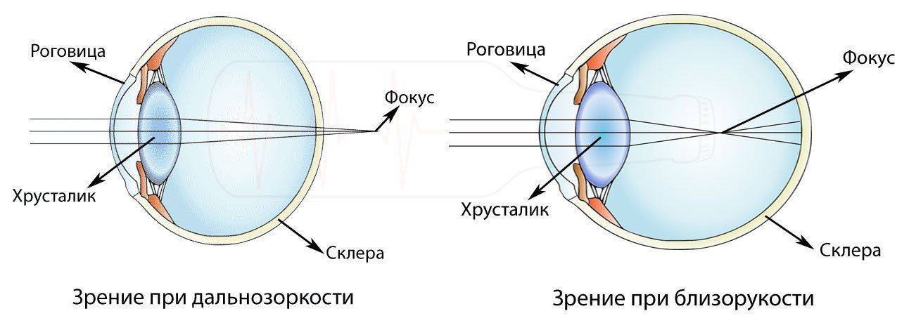 Нормальный глаз схема. Схема строения глазного яблока при близорукости. Строение глаза миопия. Дальнозоркость и близорукость строение глаза. Близорукость строение глаза.