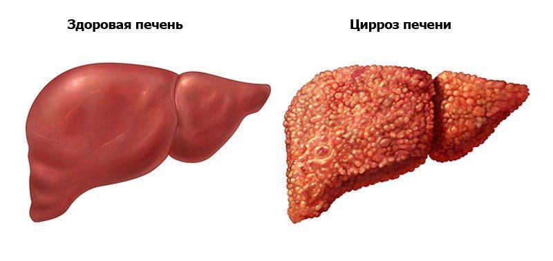 Различия гепатита и цирроза печени