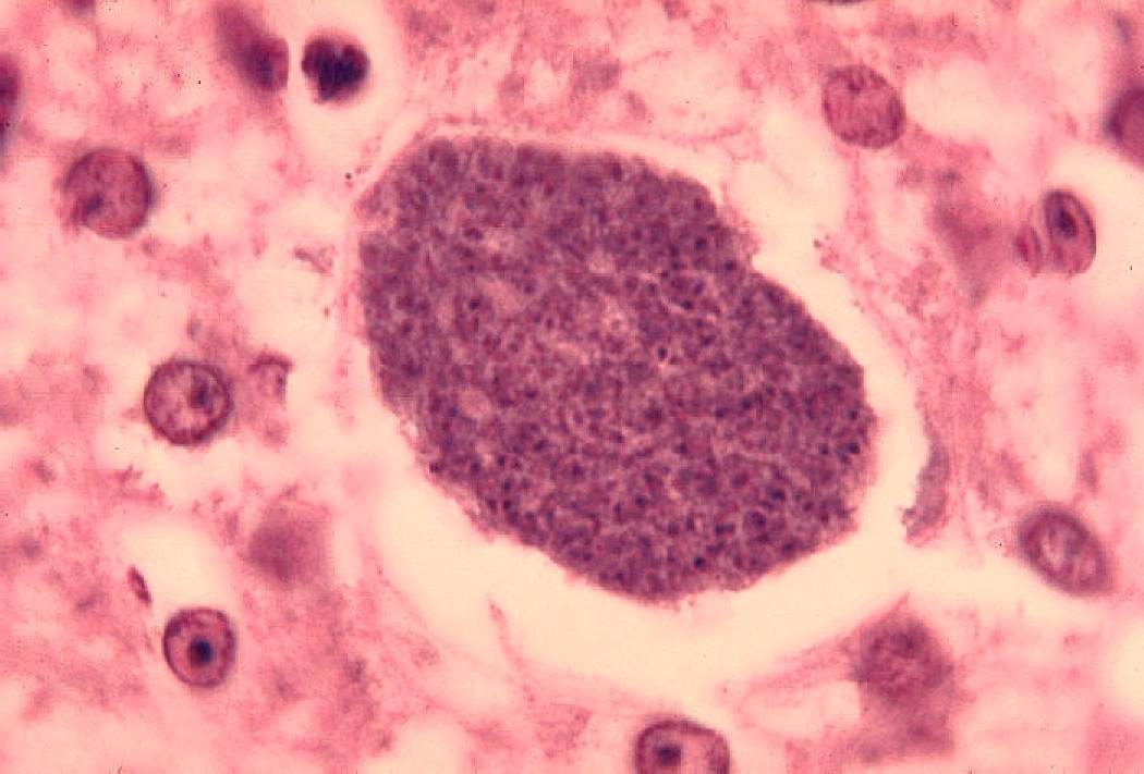 Особенности гепатоза печени, его причины и методы лечения