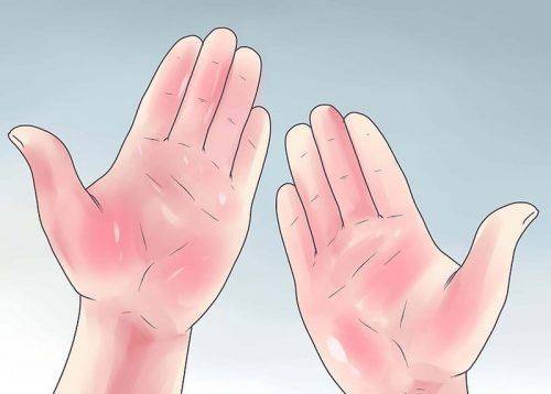 Руки свидетельствуют о болезни печени