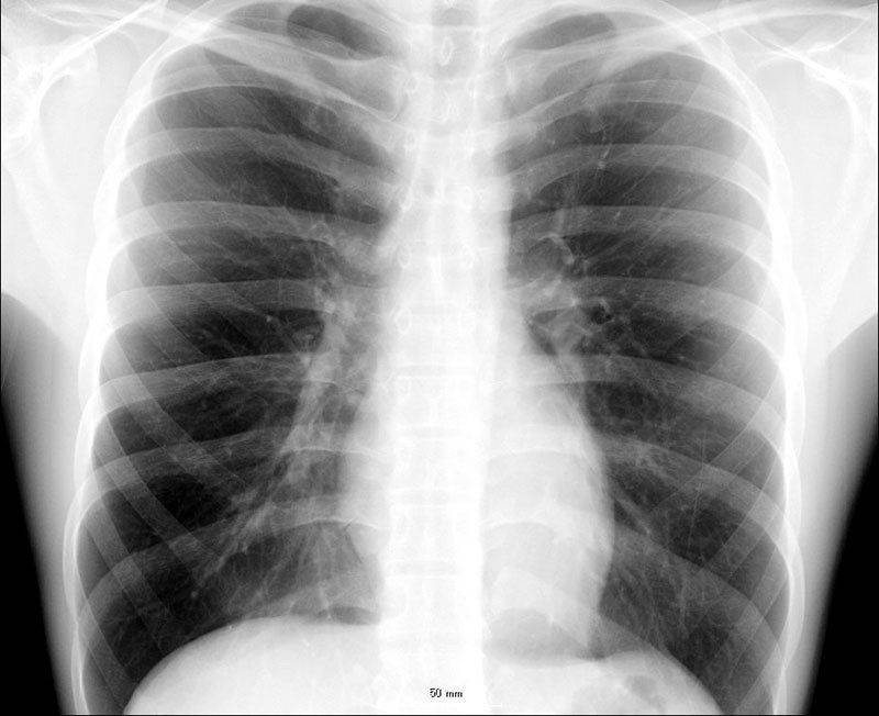 Рентгенологический снимок легких