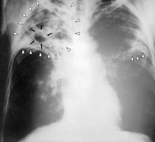 Туберкулез легких на рентгенологическом снимке