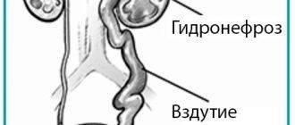 Беременность и гидронефроз