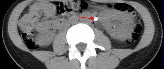 Конкременты в мочеточнике