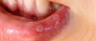 Стоматит на губе