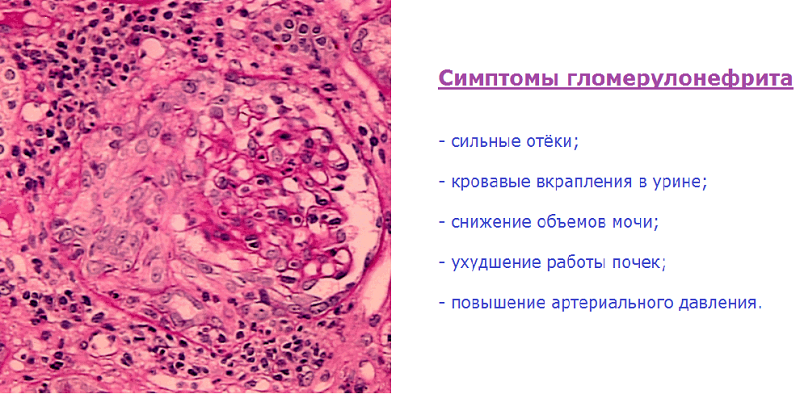 Симптомы гломерулонефрита