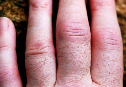 Пальцы при ревматоидном артрите