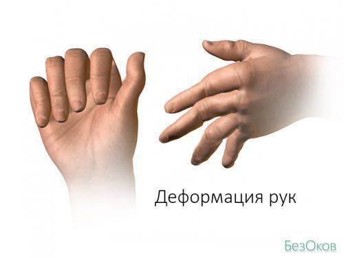 Деформация рук