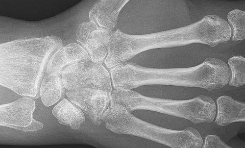 Рентгеновский снимок руки