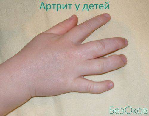 Артрит пальцев рук у детей