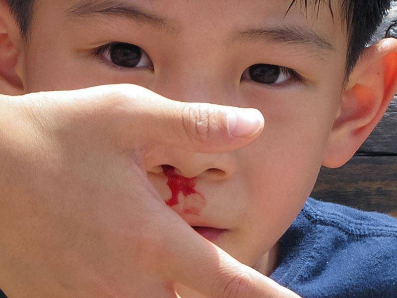 Кровь из носа у ребенка
