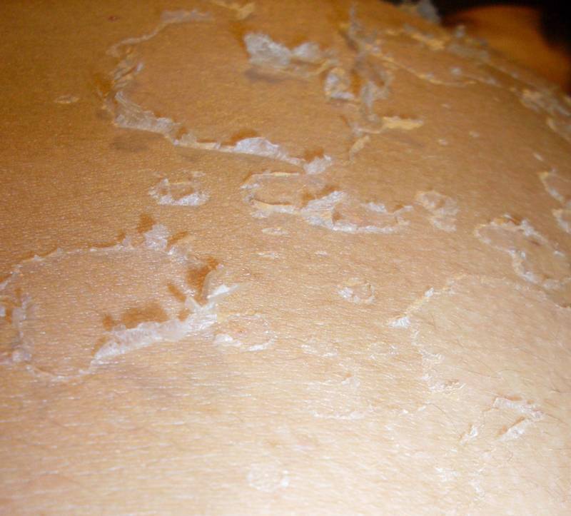 Почему у взрослых шелушится кожа на теле и что делать?