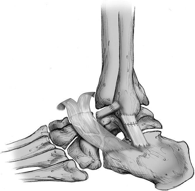 Часть голеностопного сустава. Кости голеностопного сустава анатомия. Пяточная кость анатомия человека. Капсульно-связочный аппарат голеностопного сустава. Передняя таранно малоберцовая связка голеностопного сустава.